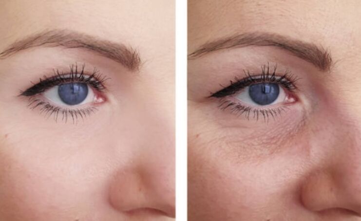 Antes y después del rejuvenecimiento con plasma alrededor del ojo