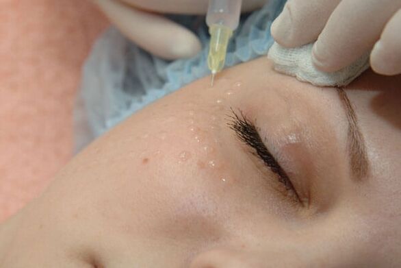Mesoterapia - Método de Inyección para el Rejuvenecimiento Facial