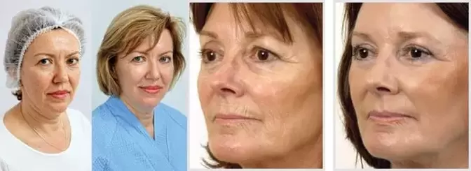 El rejuvenecimiento facial con láser reduce las arrugas