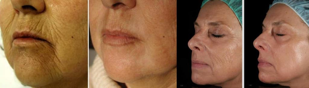 Piel del rostro antes y después de la cirugía de rejuvenecimiento con láser. 